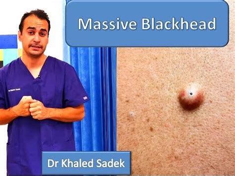 Massive Blackhead Removed Dr Khaled Sadek Lipomacyst Com