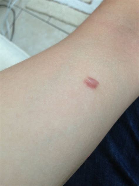 Ive Had This Little Red Bump On My Arm For A Couple Years Now I Have