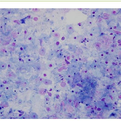 Aspiration Cytology Of The Intracystic Fluid Showing Mature Squamous