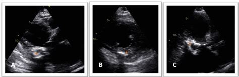 Two Dimensional Transthoracic Echocardiography Parasternal Long Axis