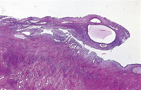 Benign Gynecologic Lesions Vulva Vagina Cervix Uterus Oviduct Ovary Ultrasound Imaging Of