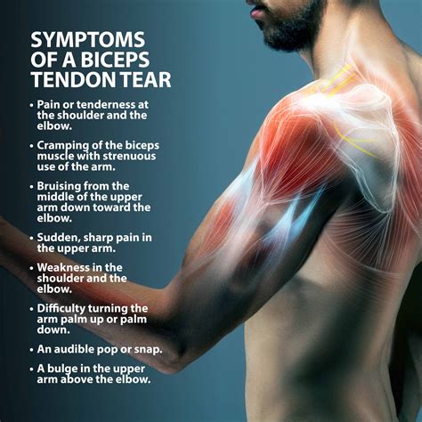 Bicep Tendon Tear Info Florida Orthopaedic Institute