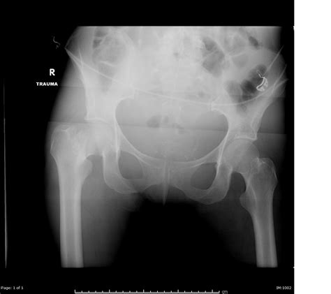 Femoral Neck Fractures Trauma Orthobullets