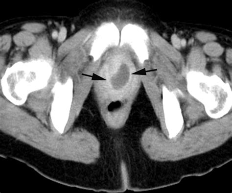 Imaging Of Female Urethral Diverticulum An Update Radiographics