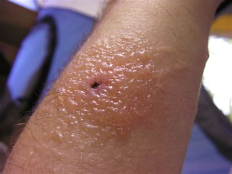 What Does A Brown Recluse Bite Look Like At First Brown Recluse Spider Bites Symptoms
