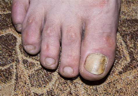 Fungal Infection Of Toenail Stock Image C0180330 Science Photo