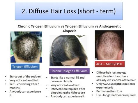 Discover Diffuse Pattern Hair Loss Best Ceg Edu Vn