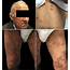 Leprosy Skin Lesions Legend  Erythemato Violaceous Papules And