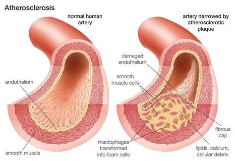 Atherosclerosis Symptoms And Causes