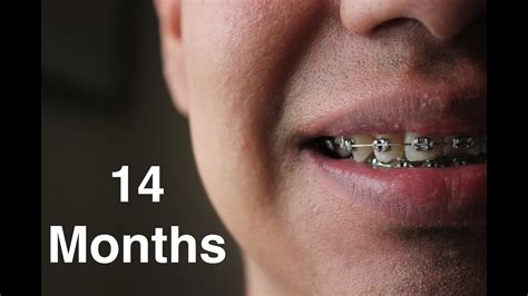 Adult Braces 14 Month Update Youtube