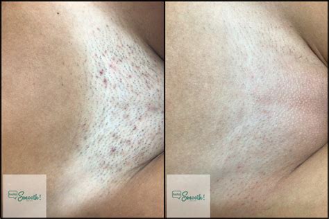 Laser Hair Removal Before And After Women