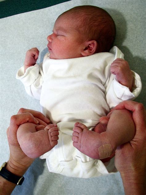 Clubfoot In Babies Clubfoot Barts Kids Bones