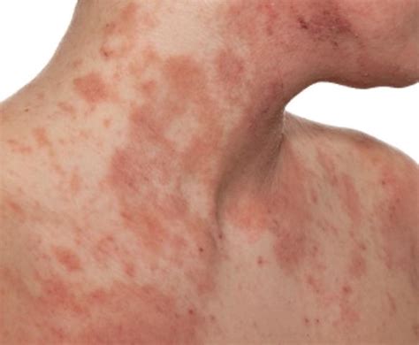 8 Eczema Symptoms To Look Out For The Luxury Spot