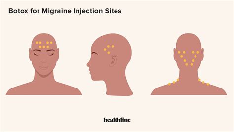 Migraine Botox Injection Sites Diagram