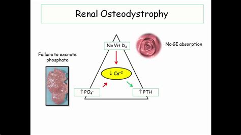 Renal Osteodystrophy Pathogenesis