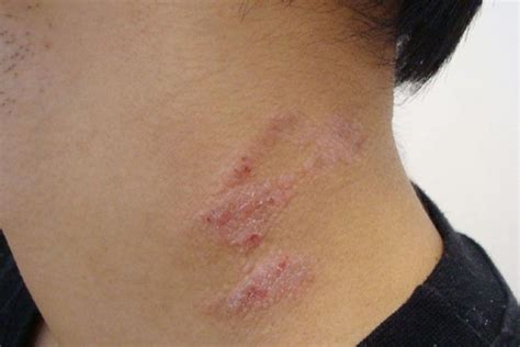 How To Get Rid Of Rash On Neck