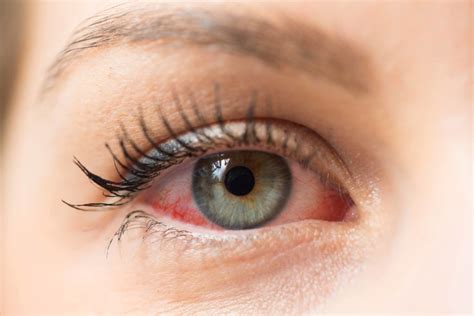 Lasik Eye Surgery Risks 8 Signs That Your Lasik Failed