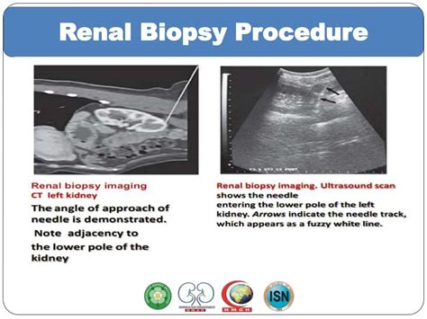 Renal Biopsy