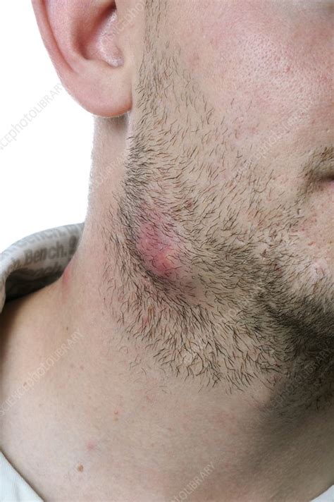 Abscess In The Lower Jaw Stock Image C0106655 Science Photo Library