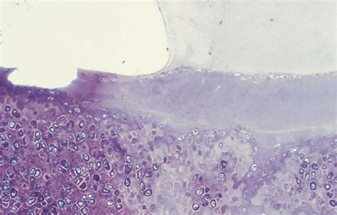 Pseudocyst Of The Auricle Diagnosis And Management With A Punch Biopsy