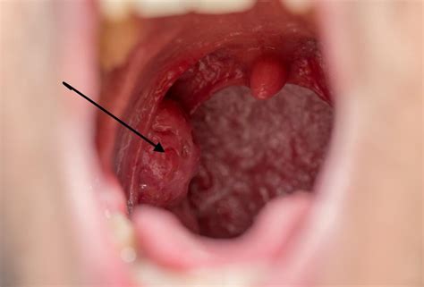 Holes In Tonsils Causes Symptoms And Treatment
