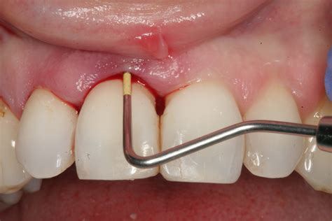 Gum Abscess All About Dental Abscesses Tooth Abscesses And Drainage