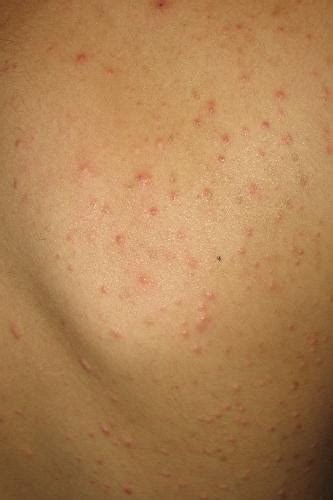 Allergic Skin Rashes Pictures 1st In