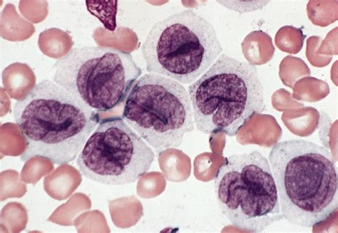Acute Monocytic Leukemia Blood Smear Wbc Anomalies Platelets Smudge