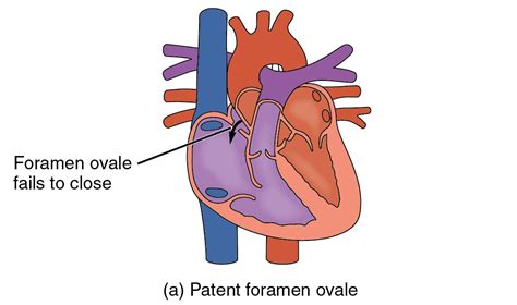 รู้จักกับ Pfo Patent Foramen Ovale หรือสภาวะหัวใจห้องบนมีรูรั่วถึงกัน
