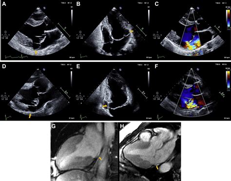 Arrhythmic Mitral Valve Prolapse And Mitral Annulus Disjunction In