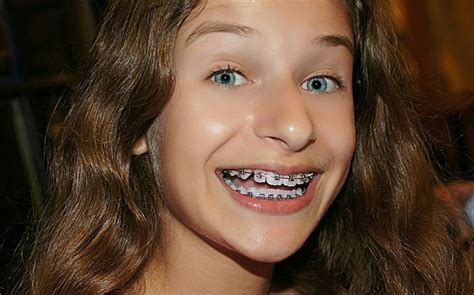 Pin By Robert Dubray On Girls In Braces In 2021 Beautiful Girl Braces