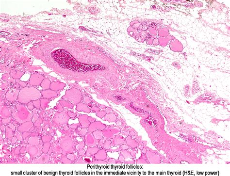 Pathology Outlines Ectopic Thyroid Tissue