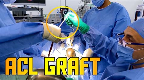 Acl Graft Medical Awareness Grafting Acl