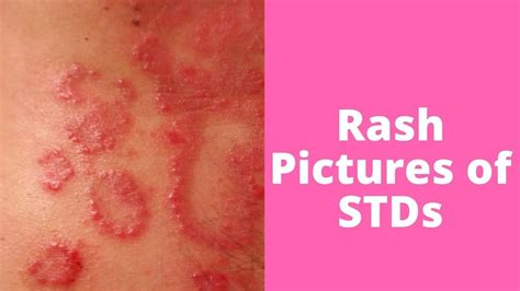 Whats This Rash Pictures Of Stds Ringworm Acne Free Face Warts On