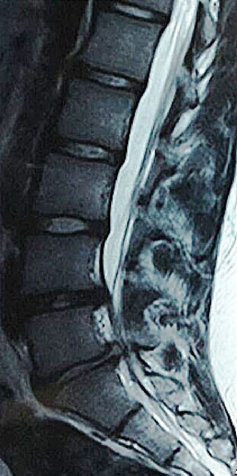 T2 Weighted Sagittal Mri Image Disc Herniation In L4 L5 And L5 S1