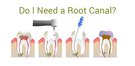 We did not find results for: Root Canal Treatment: 5 Common Myths Debunked