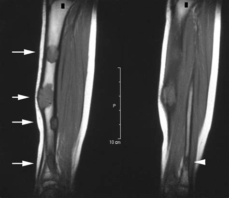 Mri Of Adamantinoma Of Long Bones In Correlation With Histopathology Ajr