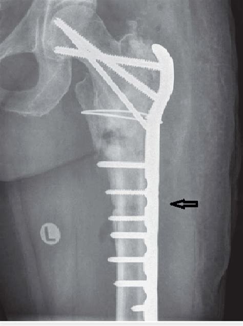 The Fracture Was Treated With Open Reduction And Internal Fixation