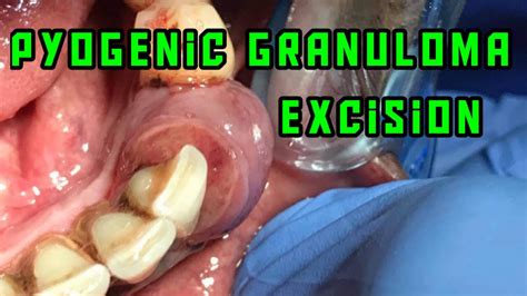 Pyogenic Granuloma Treatment And Excision Lower Mandibular Region