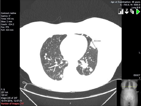 Section From Ct Scan Showing Largest Individual Lung Lesion In The
