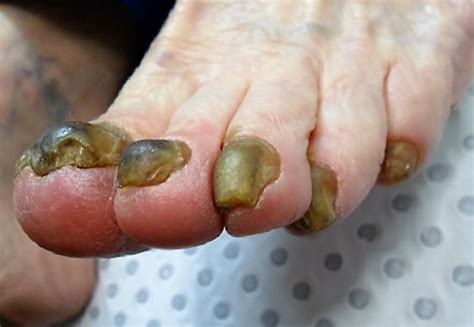 (ship from us) lanbena nail repair liquid treatment with file nail anti remove nail onychomycosis fungus toe nourishing brighten nail tslm1. New Breakthrough for Fungal Nails and Toe Nail Fungus ...