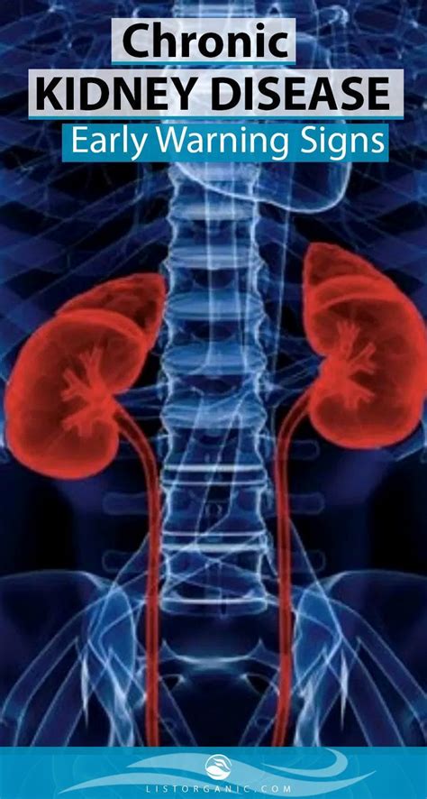 Early Detection Of Kidney Disease Chronic Kidney Disease National