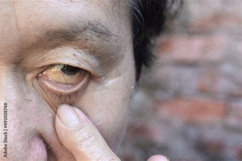 Pale Skin Of Asian Man Sign Of Anemia Pallor At Eyelid Foto De Stock