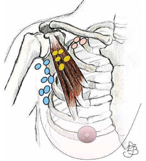 All 94 Images Pictures Of Axillary Lymph Nodes Updated