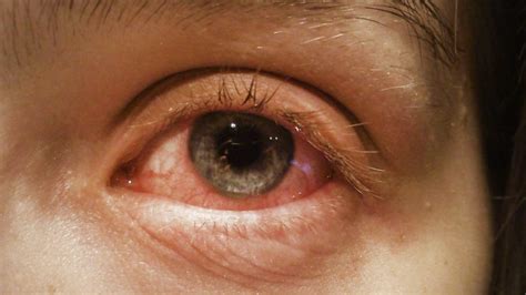 Common Eye Infections Causes And Symptoms I Lustereyes