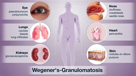 Wegners Granulomatosis Shown And Explained Using Medical Animation Still