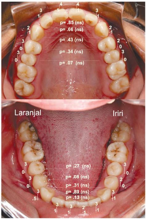 Descriptive Statistics For Tooth Wear In The Upper And Lower Jaw