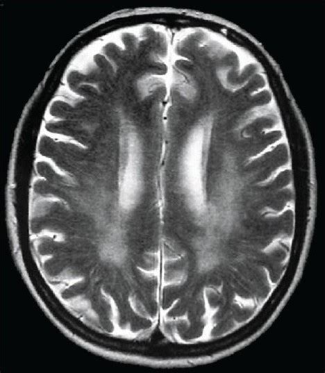 Axial T Weighted Brain Mri Diffuse White Matter High Open I