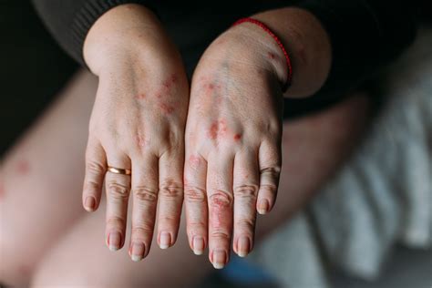 Best Ayurvedic Treatment For Eczema On Hands Primary