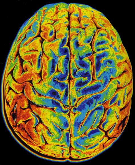 Brain Imaging Provides Window Into Consciousness